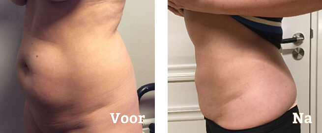 41+ Fettabsaugung vorher nachher bilder bauch , Fettabsaugung Acuraklinik Weert Plastische Chirurgie